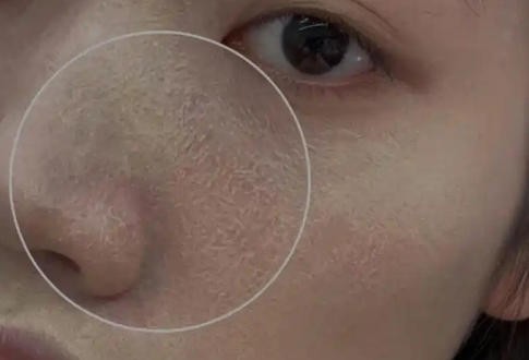 春日大干皮自救方法 以油养肤分享